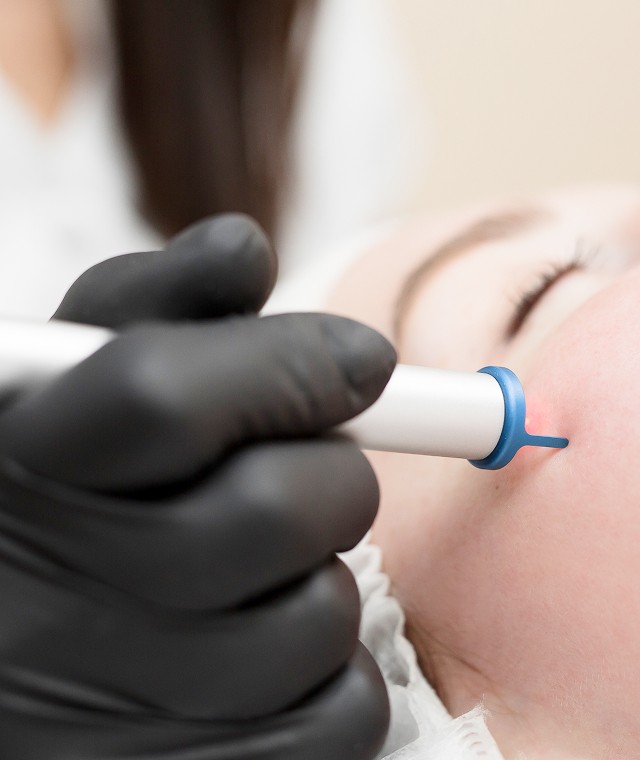 Laser hair removal